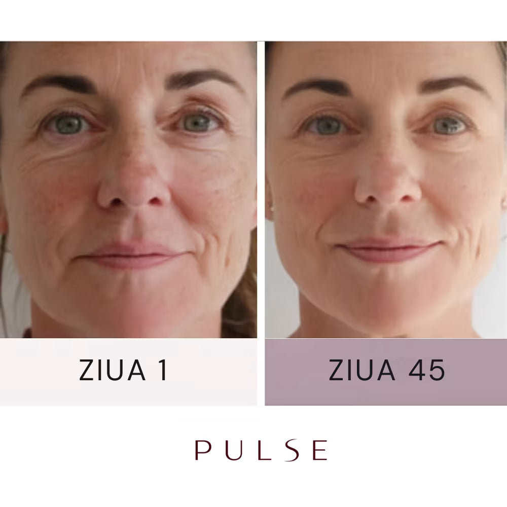 Pulse® Aparat Facial 5-în-1